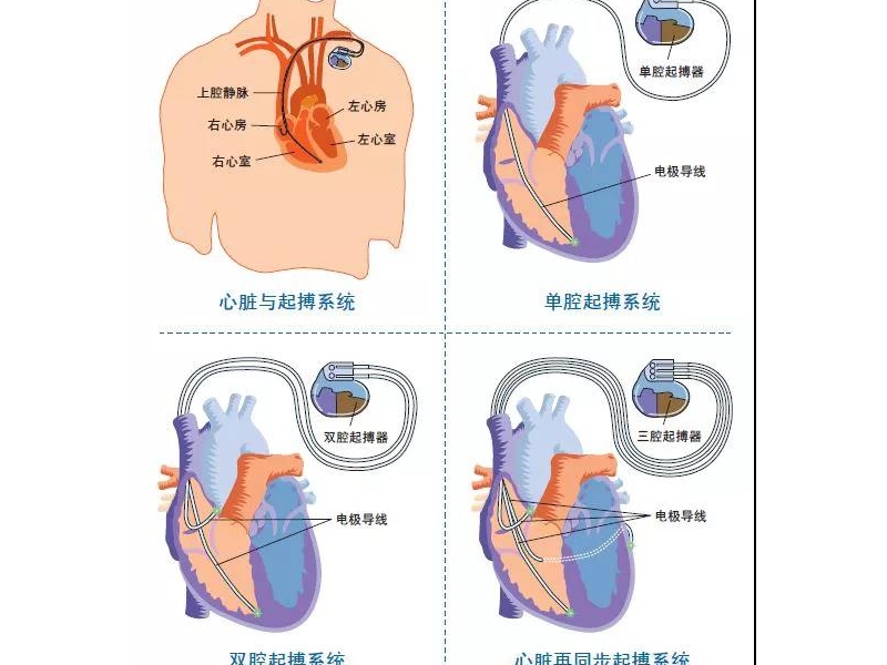銅川礦務(wù)局中心醫(yī)院開展了首例雙腔起搏器-植入型心律轉(zhuǎn)復(fù)除顫器植入術(shù)