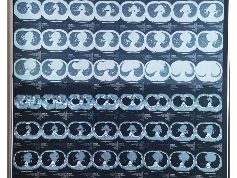 銅川礦務(wù)局中心醫(yī)院順利完成首例“烤瓷牙加工行業(yè)塵肺病”大容量灌洗