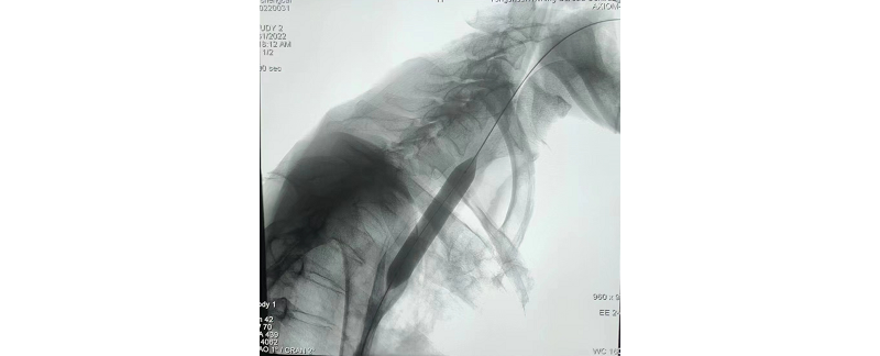 精益求精真本色，與時俱進(jìn)穩(wěn)發(fā)展--食道支架植入術(shù)