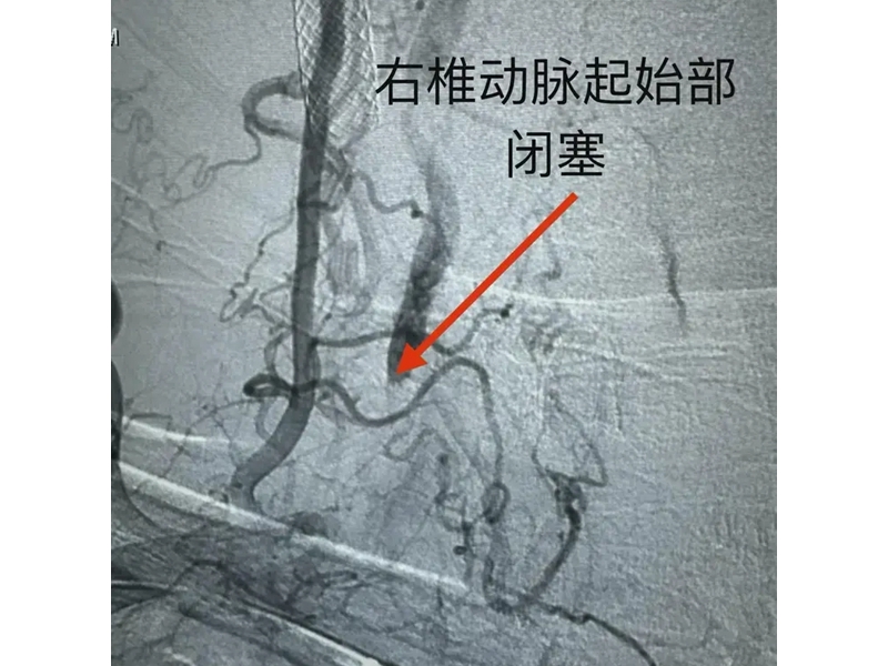銅川市首例椎動脈慢性閉塞開通術(shù)成功