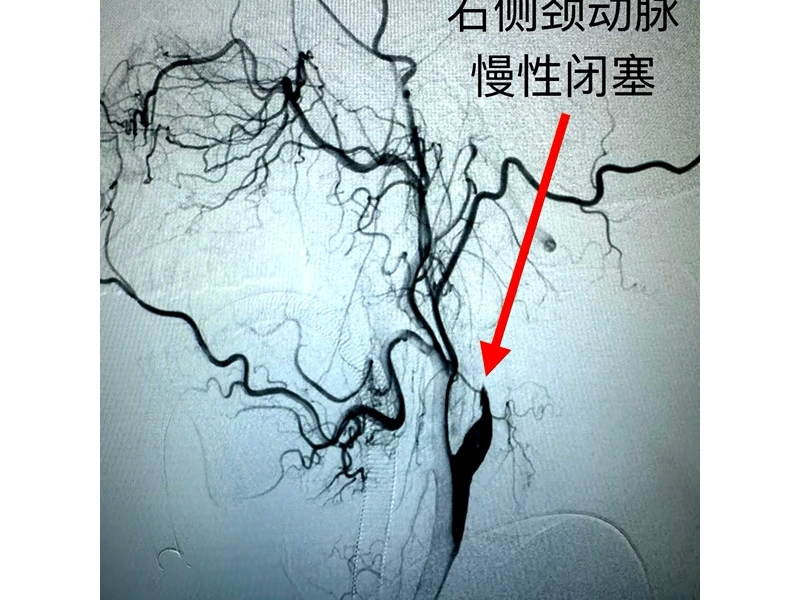 銅川礦務局中心醫(yī)院成功開展首例右側頸內(nèi)動脈慢性閉塞開通術 ...